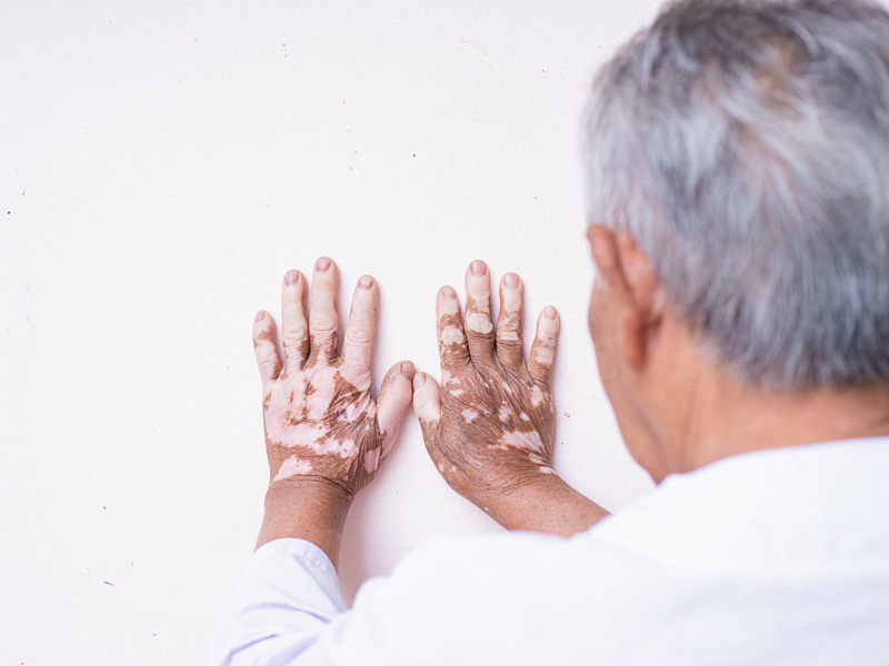 Avantages du traitement laser contre le vitiligo