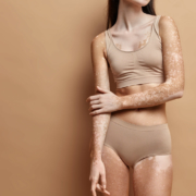Qu’est-ce que le vitiligo ?