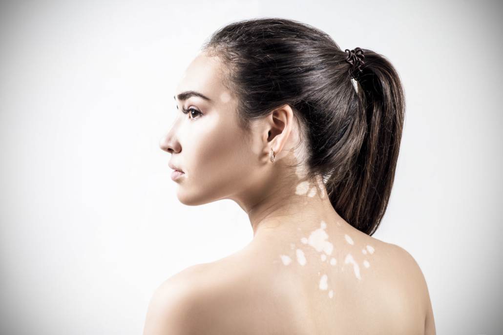 Causes et symptômes du vitiligo