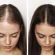 Les différentes techniques de greffe de cheveux