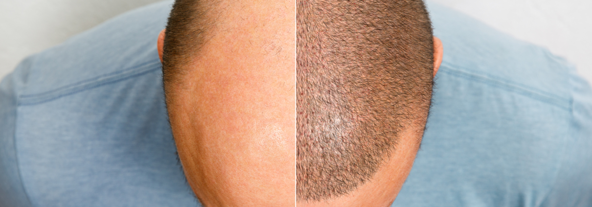 Evolution d’une greffe de cheveux après 3 mois