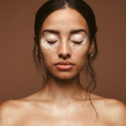 Symptômes, diagnostic et traitement du vitiligo