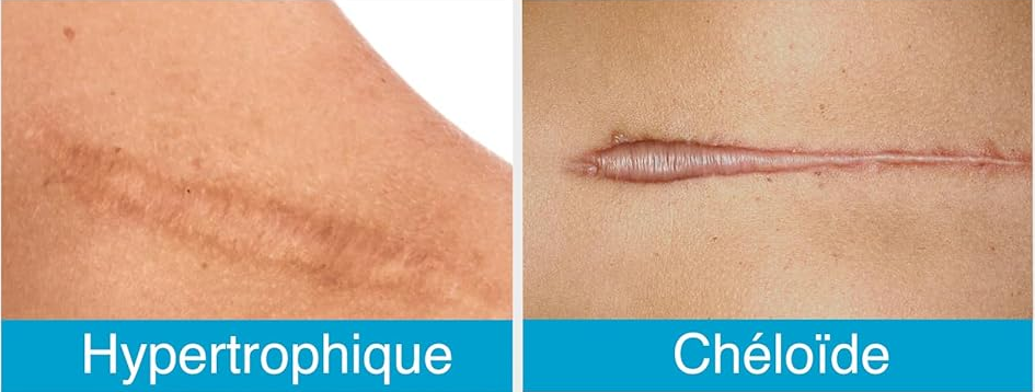 différence entre une cicatrice chéloïde et une cicatrice hypertrophique