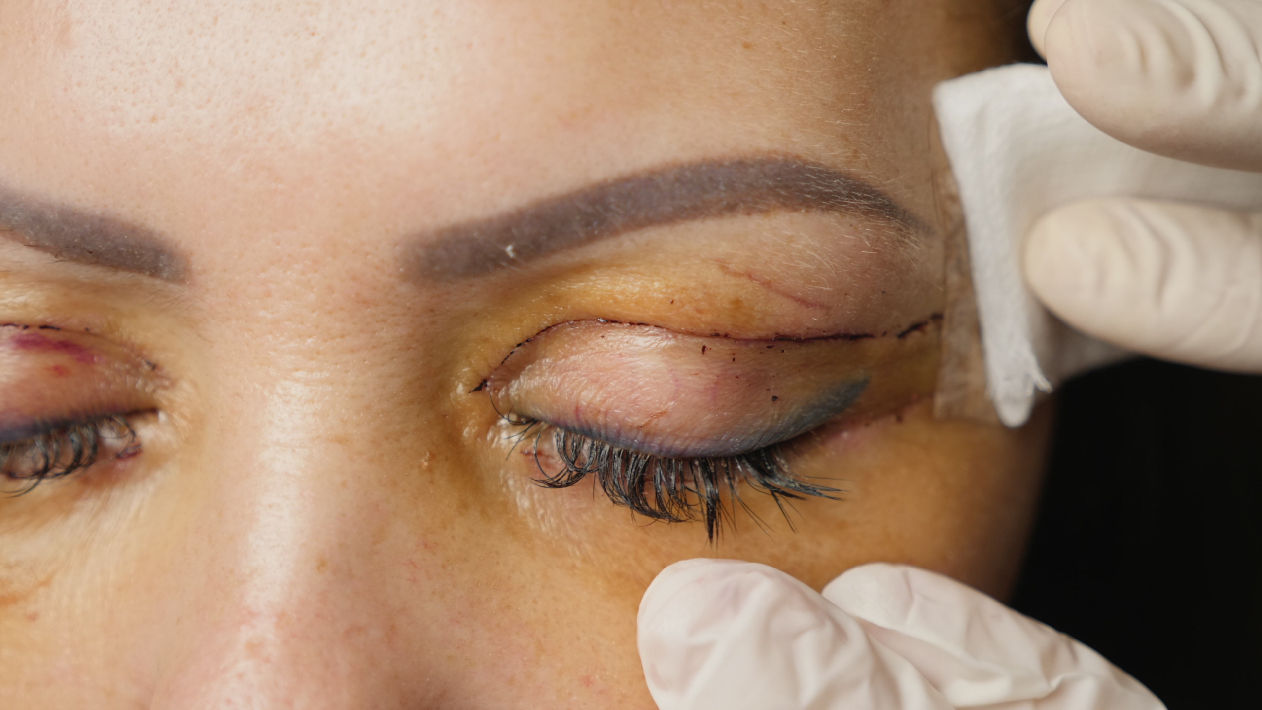 cicatrice après une blépharoplastie