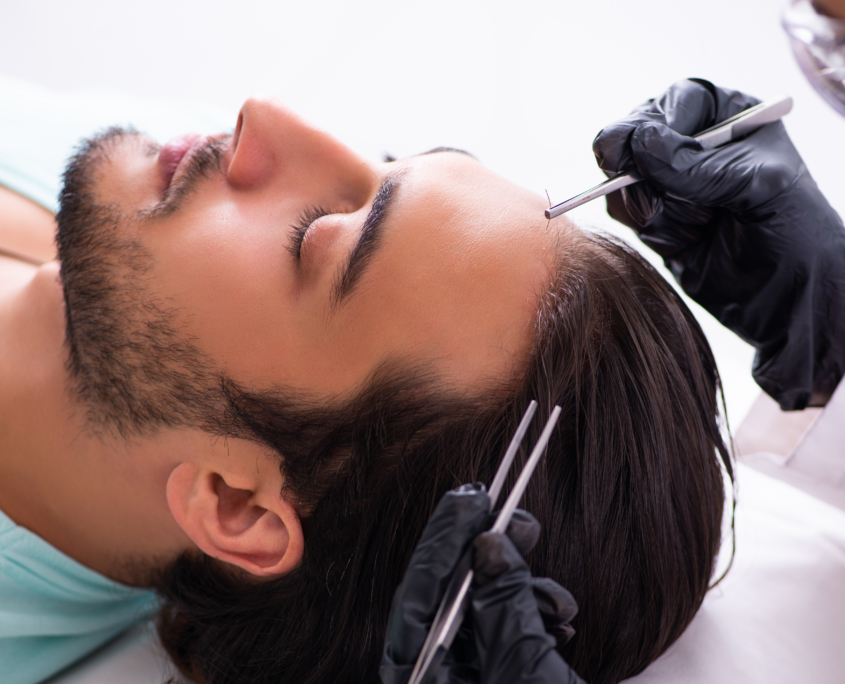 Effets secondaires normaux suite à une greffe de cheveux